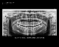 TOOTH SEGMENTATION project thumbnail