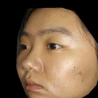 acne project thumbnail