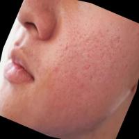 enlarged pores 3 project thumbnail