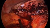 Laparoscopic Left Hepatectomy project thumbnail