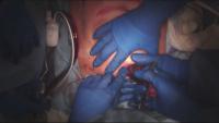 Laparoscopic Right Hepatectomy project thumbnail