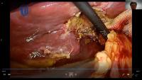 Redo Hepaticojejunostomy project thumbnail