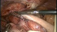 Laparoscopic Heller Myotomy project thumbnail