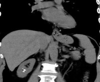 Kidney stone detection project thumbnail