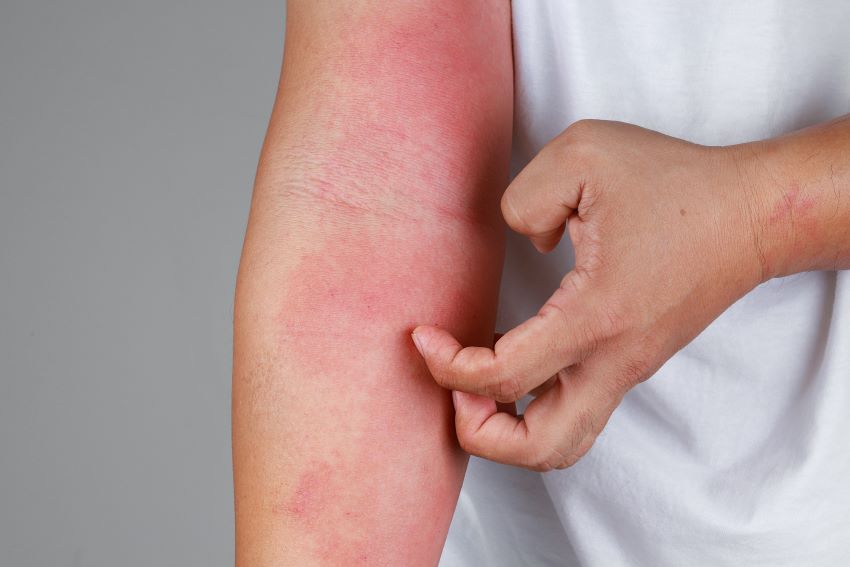 Dry, Itchy Skin
