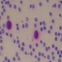 cancer in blood project thumbnail