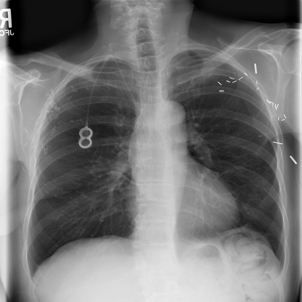 Torax-Xray-NIH-Cardiomegaly Object Detection Dataset by ToraxXrayNIH