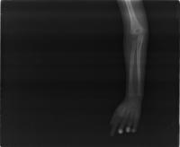 Bone Fracture data project thumbnail