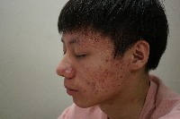 Acne Classification project thumbnail