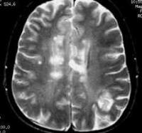 Brain_tumor_YOLO project thumbnail