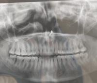 Teeth_final project thumbnail