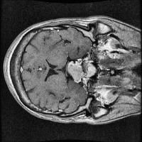 brain-tumor-segmentation project thumbnail