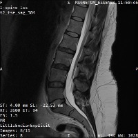 Lumbar spine project thumbnail