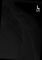 Bone fracture detection project thumbnail