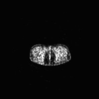 Lung cancer classification  project thumbnail