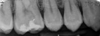 Caries-Final project thumbnail