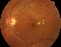 DR detection for classification project thumbnail