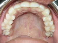 tooth segmentation project thumbnail