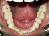 tooth detection project thumbnail