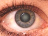 Cataract Detection project thumbnail