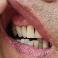 tooth detection project thumbnail