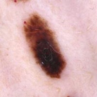 Early detection of melanoma using yolov5 project thumbnail