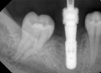 The dental implant brands recognition system project thumbnail