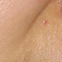 acne 2 project thumbnail
