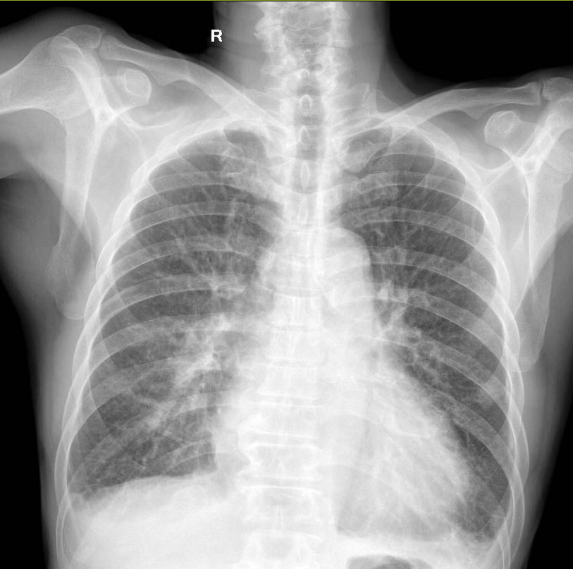pneu-tb-bronch Classification Model by mhrdkx