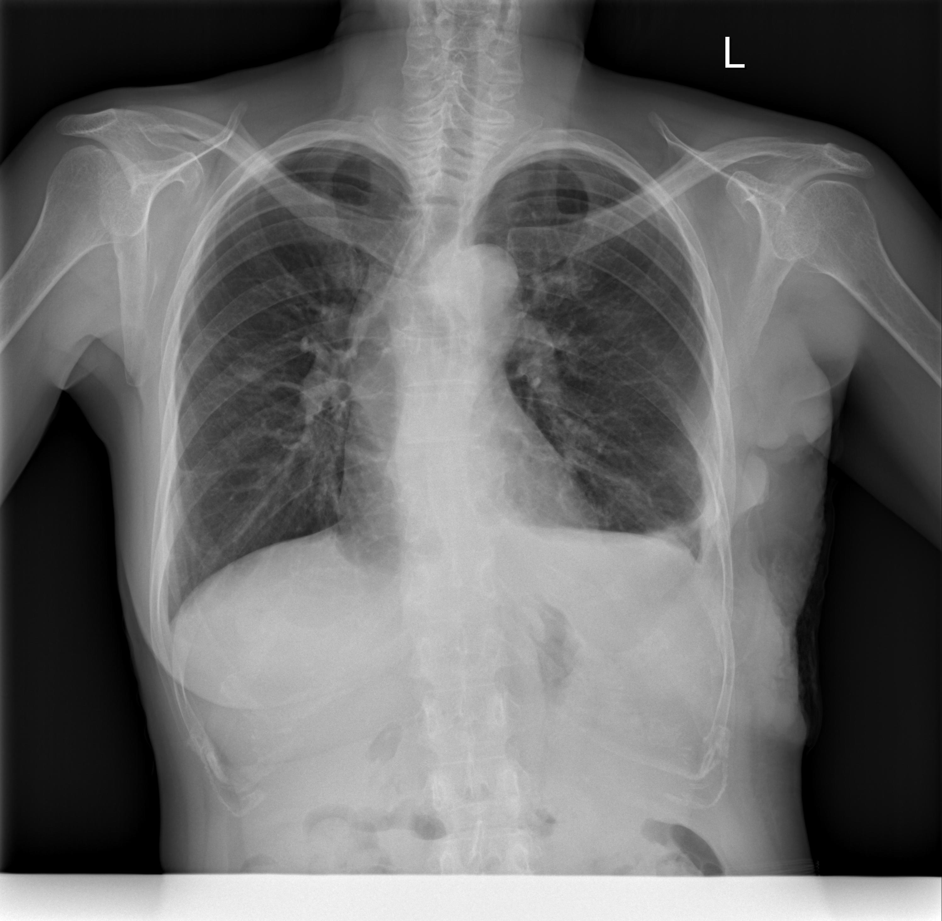 class-copd-emphysema-roboflow-universe-search