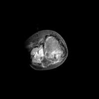 Osteosarcoma/Gado project thumbnail