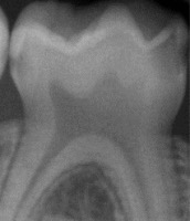 lower teeth project thumbnail