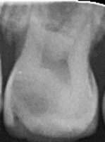 upper teeth project thumbnail