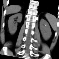 Kidney project thumbnail