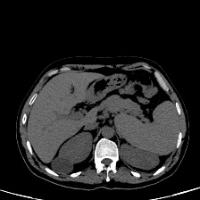 Kidney project thumbnail