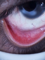 eye conjunctiva detector project thumbnail