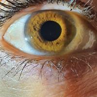 iris-lacuna project thumbnail