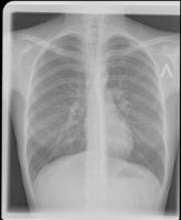 TB Xray  project thumbnail