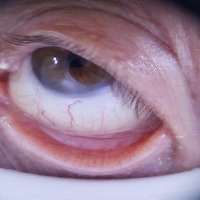 Anemia Detection Ultrasets project thumbnail