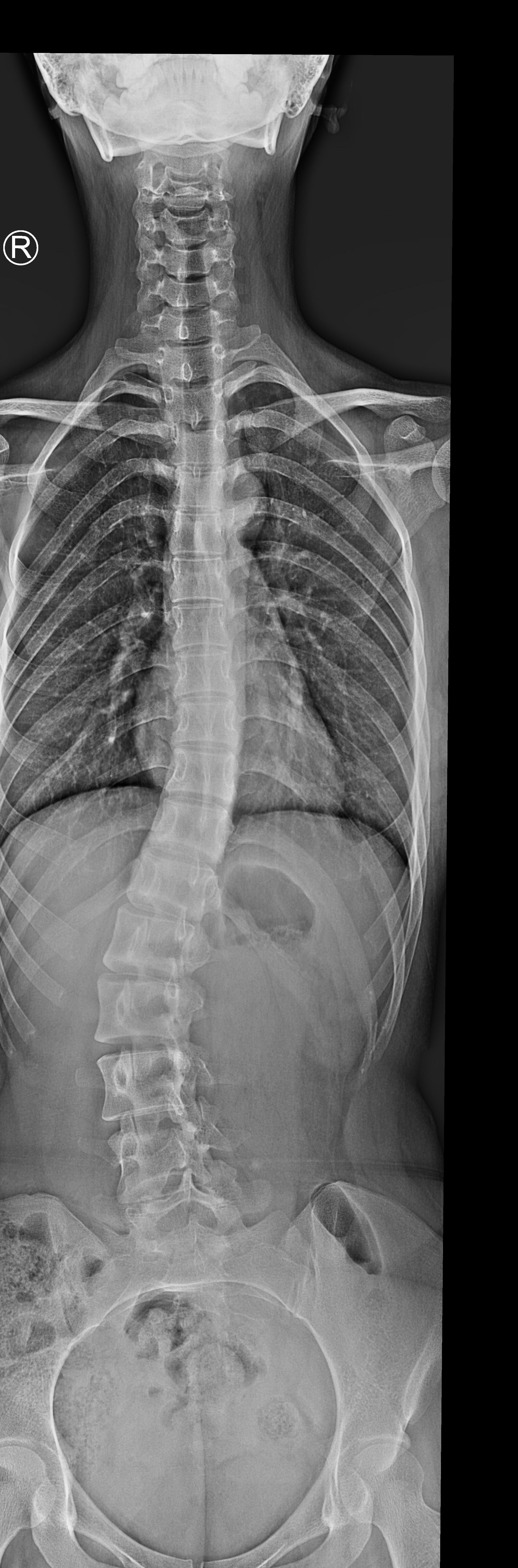AASCI Simple Dataset Scoliosis Keypoint Detection Dataset By Bones Aasci simple dataset scoliosis keypoint detection dataset by bones