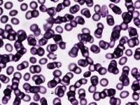 Malaria Detection project thumbnail