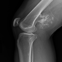 BONE CANCER SEGMENTATION project thumbnail