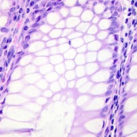 detecting colon cancer project thumbnail