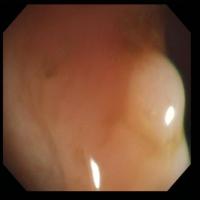 colon detection1 project thumbnail