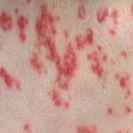 Rash/Lesion Detection Object Detection Model by SekyuTech 1