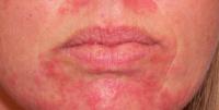 diseases of the face project thumbnail