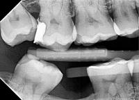 bone loss project thumbnail