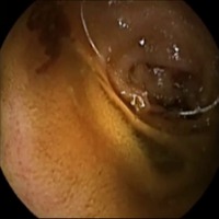 GI Bleeding project thumbnail