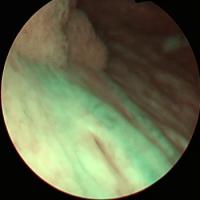 JHU Bladder Cancer project thumbnail