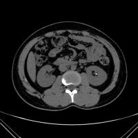 CT kidney stone 2 project thumbnail